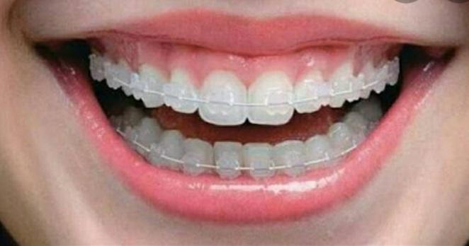 Bracket Kristal, Ceramik